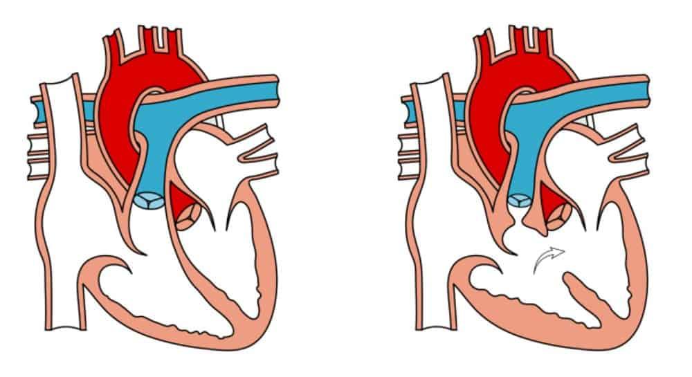 Bệnh Thông Liên Thất: Nguy Hiểm Tiềm Tàng và Tầm Quan Trọng của Điều Trị Sớm