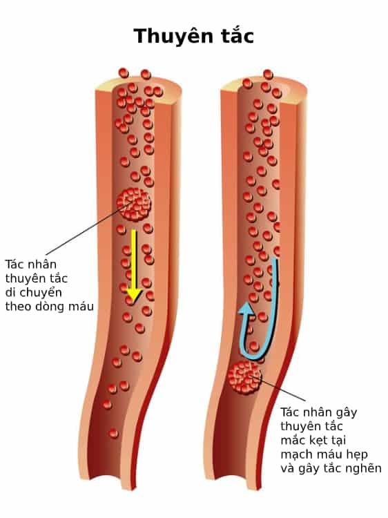 Thuyên tắc mạch máu: Nguyên nhân, Triệu chứng, Chẩn đoán và Phòng ngừa