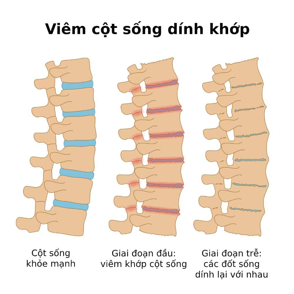 Viêm Cột Sống Dính Khớp: Nguyên Nhân, Triệu Chứng và Điều Trị