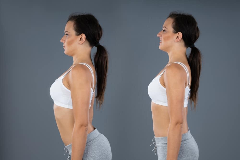 Tật ưỡn cột sống (Lordosis): Nguyên nhân, Chẩn đoán và Điều trị