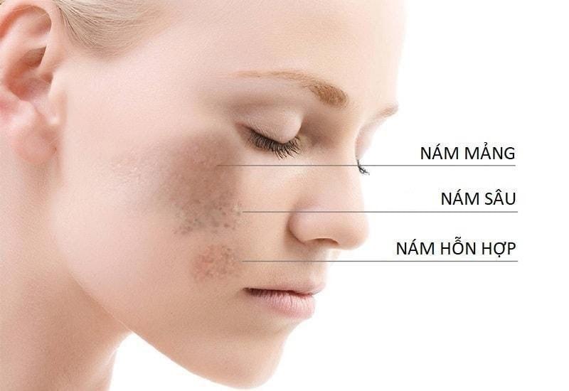 Công nghệ Mesotherapy: Giải pháp đột phá cho làn da sạch mụn, trắng sáng