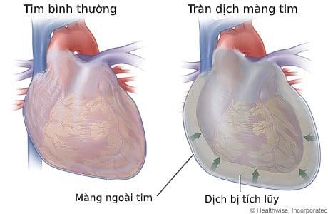 Tràn dịch màng tim: Nguyên nhân, Triệu chứng và Điều trị