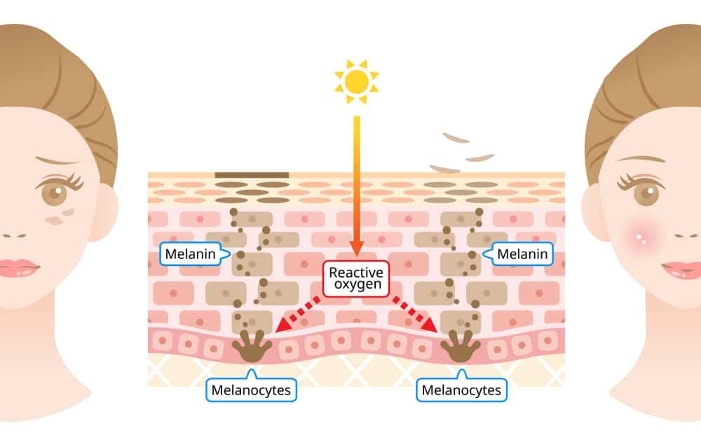 Tranexamic Acid: Thành Phần Trị Nám Hiệu Quả, An Toàn Cho Mọi Loại Da