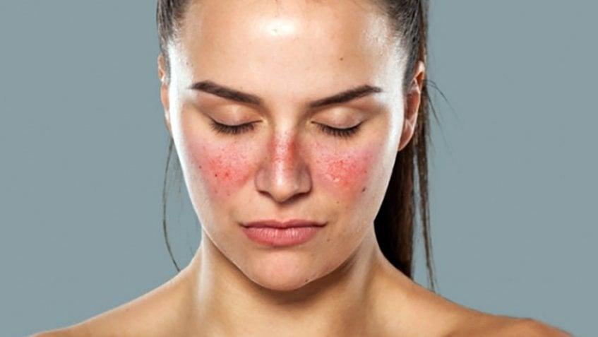 Bệnh Lupus Ban Đỏ: Nguyên Nhân, Triệu Chứng và Phương Pháp Điều Trị Toàn Diện