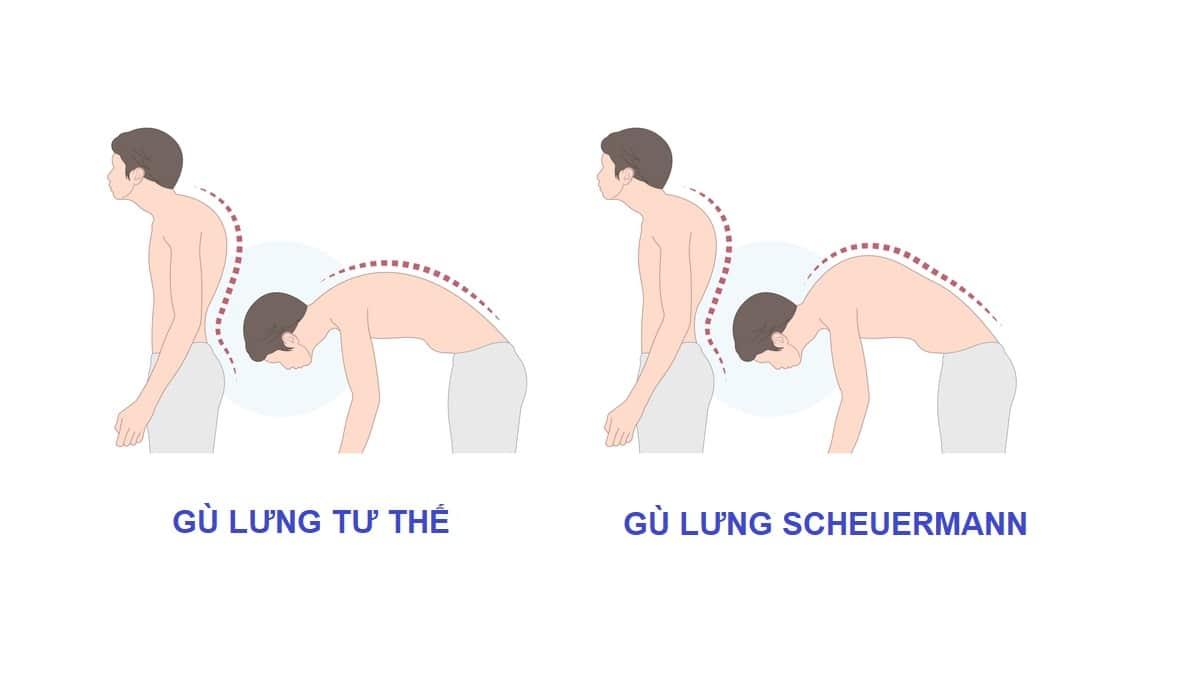 Gù lưng trẻ em: Nguyên nhân, triệu chứng và phương pháp điều trị