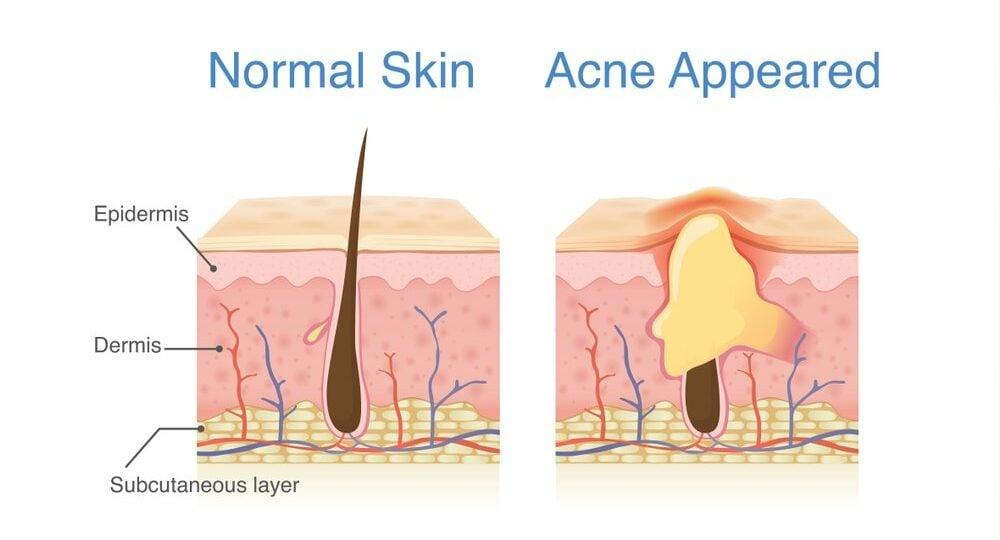 Acnotin: Thuốc Trị Mụn Hiệu Quả Nhưng Cần Sử Dụng Cẩn Thận