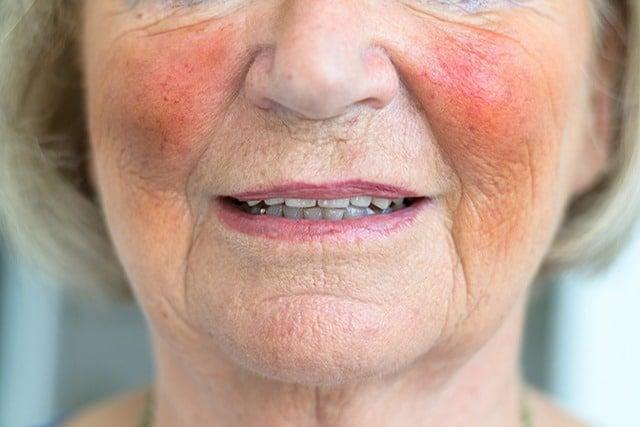 Hội chứng Carcinoid: Nguyên nhân, Triệu chứng, Chẩn đoán và Điều trị