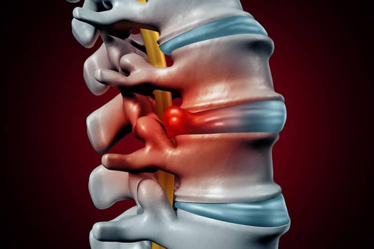 Lồi đĩa đệm: Triệu chứng, Nguyên nhân, Chẩn đoán và Điều trị