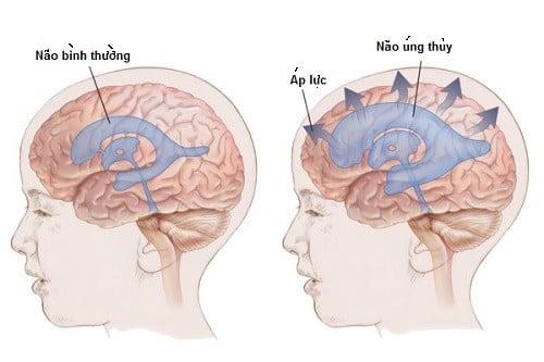 Bệnh não úng thủy ở trẻ sơ sinh: Nguyên nhân, triệu chứng, chẩn đoán và điều trị