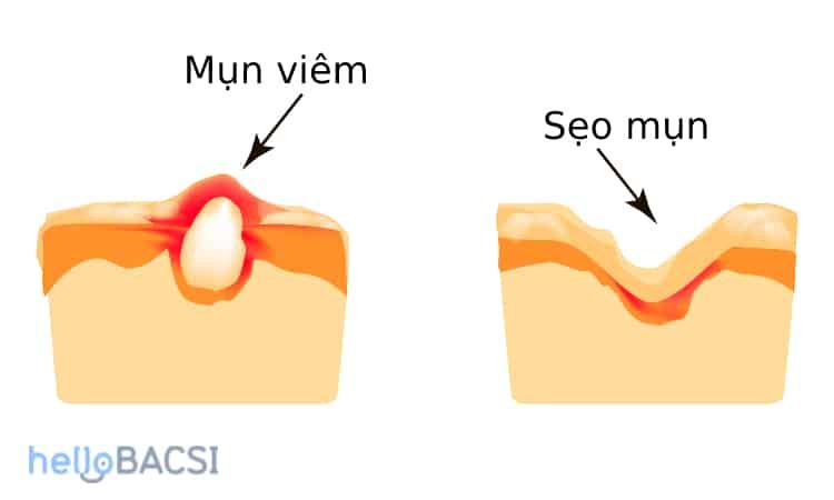 Hướng dẫn toàn diện về sẹo mụn: Nguyên nhân, các loại và biện pháp phòng ngừa