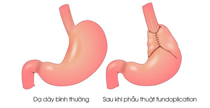 Phẫu thuật Điều trị Trào ngược Dạ dày Thực quản (GERD): Hướng dẫn Toàn diện