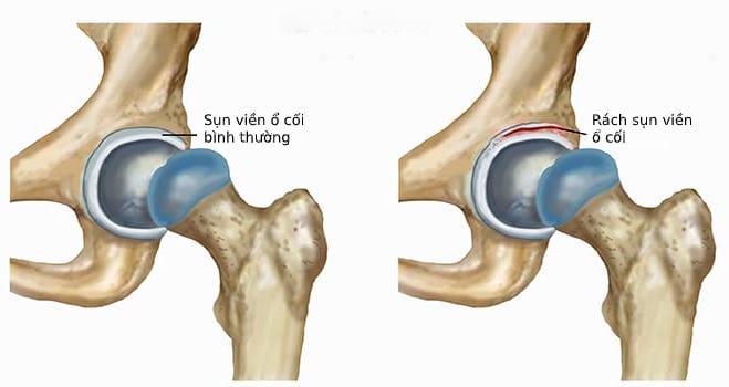 Rách sụn viền ổ cối: Nguyên nhân, Triệu chứng và Các lựa chọn điều trị