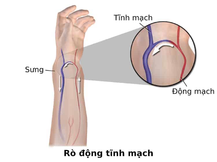 Rò Động Tĩnh Mạch: Tổng Quan, Nguyên Nhân, Triệu Chứng, Chẩn Đoán và Điều Trị