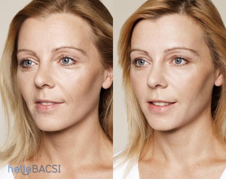 Restylane và Botox: Hướng dẫn toàn diện về hai chất làm đầy da hàng đầu