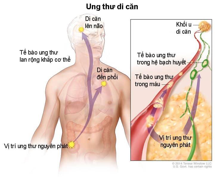 Ung thư di căn đến phổi: Triệu chứng, chẩn đoán và phương pháp điều trị