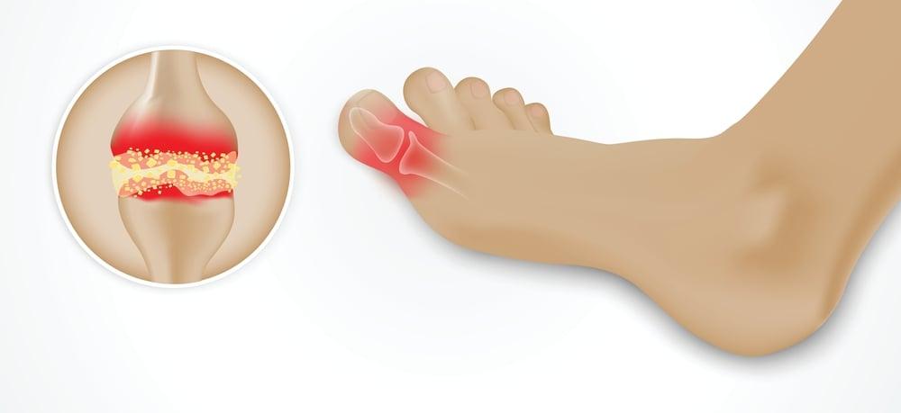 Bệnh Gout Cấp: Nguyên nhân, Triệu chứng, Chẩn đoán và Điều trị