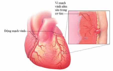 Triệu chứng thiếu máu cơ tim: Nhận biết và cải thiện sớm