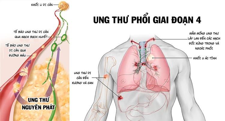 Ung thư Phổi Di Căn Xương: Triệu Chứng, Tác Động và Các Lựa Chọn Điều Trị