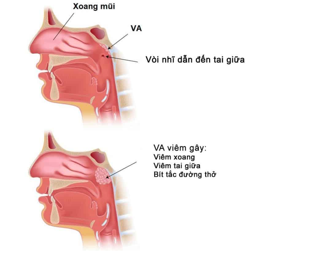 Viêm VA: Nguyên nhân, Triệu chứng, Chẩn đoán và Điều trị