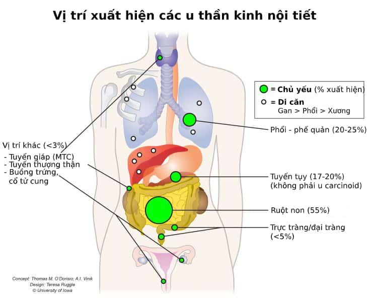 Hiểu sâu về U Thần Kinh Nội Tiết: Triệu chứng, Nguyên nhân và Phương pháp Điều trị