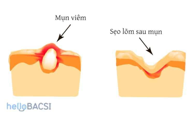 Hướng dẫn Toàn diện về Sẹo Mụn: Phân loại, Nguyên nhân và 10 Cách Trị Sẹo Mụn Tại Nhà Hiệu Quả