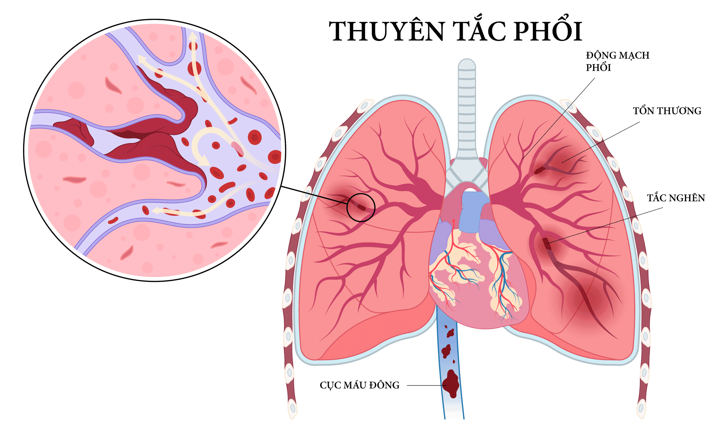 Phẫu thuật tiêu hóa và biến chứng thuyên tắc huyết khối tĩnh mạch