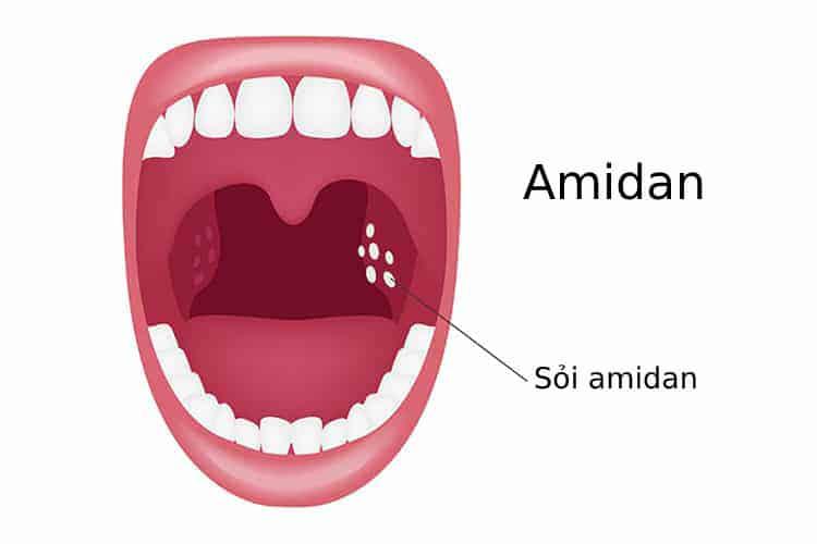 Sỏi amidan: Nguyên nhân, cách lấy tại nhà và phương pháp điều trị