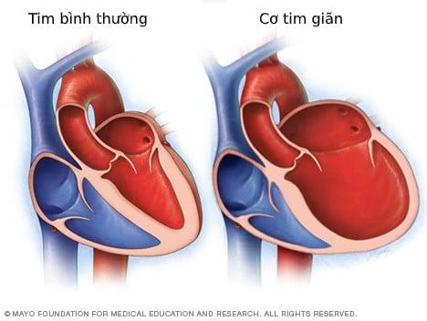 Bệnh cơ tim giãn: Triệu chứng, nguyên nhân, chẩn đoán và điều trị