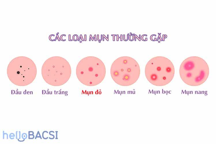 Mụn Đỏ Do Căng Thẳng: Nguyên Nhân, Biểu Hiện và Cách Ngăn Ngừa