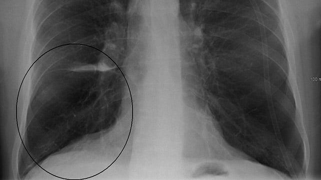 Chẩn đoán Bệnh Phổi Tắc Nghẽn Mạn Tính (COPD) Toàn Diện