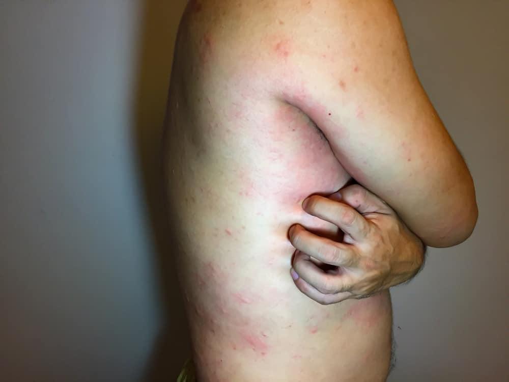 Bệnh Lupus: Nguyên nhân, Triệu chứng, Chẩn đoán và Điều trị