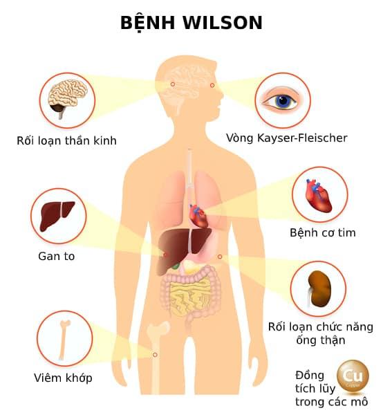 Bệnh Wilson: Một Hướng Dẫn Toàn Diện